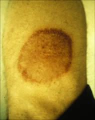LYME DISEASE: ERYTHEMA MIGRANS
*also present with fever, chills, stiff neck