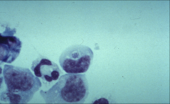 Ehrlichiosis: Morulae
*looks like a cluster of berries (the bacteria inside a monocyte
*HME
