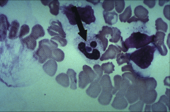 Ehrlichiosis: Morulae
*the bacteria inside a PMN.
*HGE
