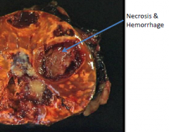 Rare
>200-300 grams; 5 cm in diameter
Invasive
Necrosis/hemorrhage
invade adrenal vein and vena cava
If poorly differentiated it will have more color in cytoplasm, large nuclei, and a lot of irregularity
