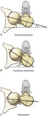 femoral neck is rotated 15 deg anterior = anteversion