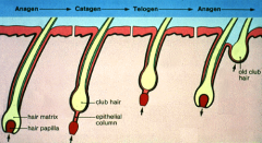 telogen effuvium may follow cytotixic therapy or other stress ( tempory hair loss due to sheding of resting hair - abruptly shifted from anogen. The loss will occur some  time later ( weeks or months ) when new hairs start to grow. ( CLUB SHAPED T...