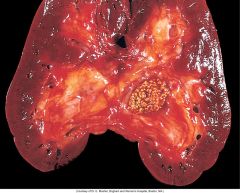 What is wrong with this kidney and what is the structure in it?