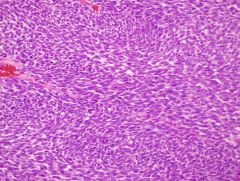 -Hypercellular
-Fascicular with herringbone pattern
-Atypia may not be significant

Seen in 
-Fibrosarcoma
-MPNST
-Synovial sarcoma