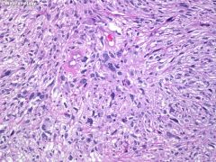 -Cellular tumor
-Bizarre nuclear atypia (giant cells, highly pleomorphic, hyperchromatic nuclei)
-Very mitotically active
-Often with necrosis