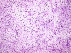 -Myxoid or edematous background
-Highly pleomorphic cells
-Frequent mitoses
-Arcing vessels