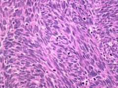 -Fascicular tumor with bundles of cells intersecting at right angles
-High mitotic rate
-Significant cytologic atypia
-Not as pleomorphic as MFH