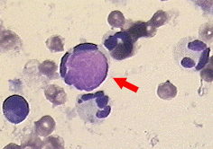 PMN leukocyte with ingested LE body, often in rosette formation