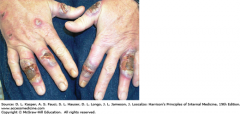 manifestation of neutrophilic dermatosis that presents as non-healing ulcer seen in IBD, RA, hematologic malignancies, 

