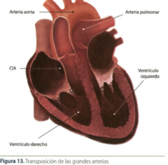 Anomalía donde la aorta se origina en el ventrí**** derecho a la derecha y por delante de la arteria pulmonar. La arteria pulmonar se origina en el ventrí**** izquierdo por detrás de la aorta.