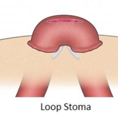 Loop colostomy

Proximal end passes stoolsDistal end passes mucus