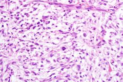 Myxofibrosarcoma
-Prominently myxoid with higher cellularity, nuclear pleomorphism, and mitotic rate compared to myxoma
-Characteristic vessels with short thick arcs (curvilinear)