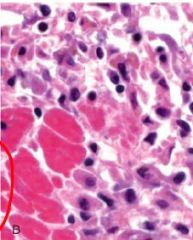 The large pink cells are myocytes that have undergone karyolysis; what other cells are present here and why/what stage of inflammatory response is this