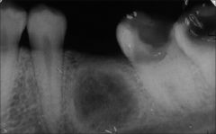 Cyst at the site of previous tooth extraction

Remnant of process that led to tooth loss versus insufficient curettage during tooth extraction versus continuation of epithelial rest inflammatory response after tooth extraction

Generally assx