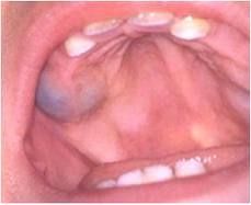 Occurs during tooth eruptions process in children less than 10yo

BLUISH CYST appears under the gingiva, can sometimes be painful