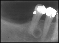 Radiolucent
SIngle lesion
Well-demarcated unilocular
LATERAL to roots of vital teeth
Usually less than 1cm in size
