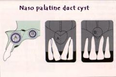 Nasopalatine duct cyst/incisive canal cyst
- forms during fusion of primary and secondary palate
- male predominance