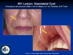 Soft tissue cyst, occurs between ala and lip from trapped epithelium during embryologic fusion; remnants of nasolacrimal duct
Female predominance, 30-50yo
Generally assx