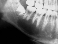 Radiolucent
Single lesion
Well-demarcate multilocular
Can scallop roots of adjacent teeth