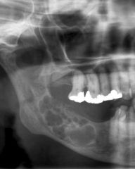 Radiolucent
Single lesion
Well-demarcated unilocular or multilocular
Resorption of tooth roots
Cortical bone expansion