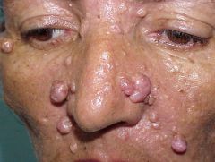 Gorlin's syndrome = Nevoid basal cell carcinoma syndrome (NBCCS)
- autosomal dominant
- multiple basal cell carcinomas
- multiple keratocystic odontogenic tumors 
- skin cysts, palmar/plantar pits
- calcified falx cerebri, increased head circ...