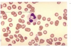 These are found in neutrophils but can also be found in monocytes and lymphocytes. They can be cause by viral infections, drugs, and burns. They can also be seen in May-Heggin.