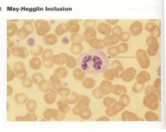These are Dohle-like bodies in neutrophils. They are surrounded by abnormally large and poorly granulated platelets with thrombocytopenia.