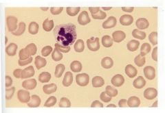 This is an abnormality seen in mature granulocytes. Frequently seen in infectious states as well as burns, malignancies, and drug therapy.