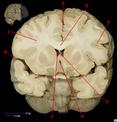 Match each structure on the image below to the correct answer from the list provided. Please note: some answers may be used more than once.

A.	fourth ventricle of brainstem
B.	Lateral ventricle of left cerebral hemisphere
C.	White matter of l...