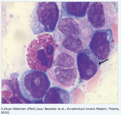 - Blastenanteil > 20% (Beweisend)
- Auer-Stäbchen (Nadelförmige, violette Kristalle im Zytoplasma der Blasten)