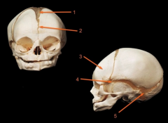 Match each structure on the image below to the correct answer from the list provided. Please note: some answers may be used more than once.

A.	frontal suture
B.	frontal bone
C.	sphenoidal (anterior lateral) fontanel
D.	anterior fontanel
E.	...