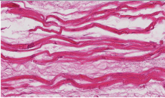 Thin wavy myocytes: sometimes present,
sometimes the earliest microscopic evidence
of myocardial infarction, as early as 30 minutes
after it has occurred