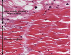 What is show in the image here? 
What are the viable myocytes with myoctyolysis also called?