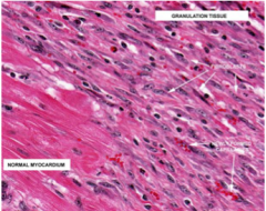 This is a subacute (healing phase) myocardial infarction at 2-3 weeks with numerous fibroblasts and multiple new-grown blood vessels (neovascularization), which tend to come about the same time as fibroblasts, later than lymphocytes and
macrophages.
