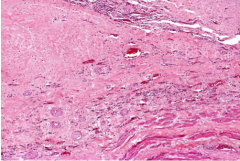 This is a very late subacute infarct, almost completely converted to a scar. Just a few lymphocytes still hanging around (surveying the work of the macrophages and fibroblasts they bossed around).
�