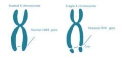 -The long arm of the x chromosome has an elevated number of repeated DNA sequences. 
-More common challenges.
Is associated with being mentally challenged; is second in occurrence to. Downs syndrome