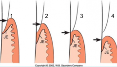  
  Base of sulcus (BOS) and JE are on enamel

  BOS on enamel and part of JE is on the root 

 BOS is at CEJ and entire JE on cementum

  Both BOS and JE on root 