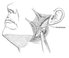 3. Develop flaps deep to the platysma and superficial to the parotid (anterior and inferior to the margin of the parotid gland, cephalad to the zygomatic process, and posterior to the sternocleidomastoid muscle).