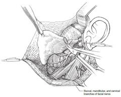 10. Dissect in the plane between the parotid gland and facial nerve branches, tracing, and preserving each branch of the facial nerve.