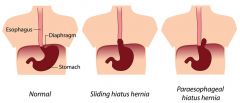 1. sliding hiatal hernia (type 1) - accounts for 905 of cases. Both the gastroesophageal (GE) junction and a portion of the stomach herniate into the thorax through the esophageal hiatus (so that the GE junction is above the diaphragm)- this a com...