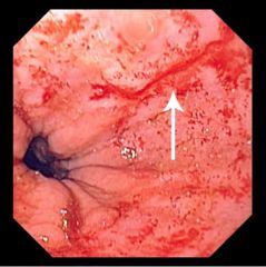 1. mucosal tear at (or just below) the GE junction as a result of forceful vomiting or retching. It usually occurs after repeated episodes of vomiting, but it may occur after one episode
2. it is most commonly associated with binge drinking in al...