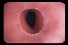 1. distal esophageal webs- a circumferential ring in the lower esophagus that is always accompanied by a sliding hiatal hernia
2. It is usually asymptomatic, but mild to moderate dysphagia may be present
3. If the patient is symptomatic (but has...