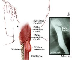1. most esophageal diverticula are caused by an underlying motility disorder of the esophagus
2. Zenker's diverticulum is the most common type-- found in the upper 1/3 of the esophagus
3. Failure of the cricopharyngeal muscle to relax during swa...
