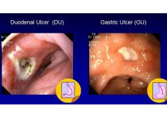 1. Endoscopy- most accurate test in diagnosing ulcers, essential in diagnosis of gastric ulcers because biopsy is necessary to r/o malignancy- duodenal ulcers not require biopsy. Preferred when severe or acute bleeding is present (can perform elec...