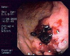 1. a type of non-hodgkins lymphoma that arises in the stomach
2. clinical features are similar to those of adenocarcinomas of the stomach (e.g. abdomina pain, weight loss, anorexia)
3. complications include bleeding, obstruction, and perforation...