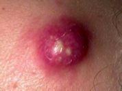 What is this condition? Explain clinical manifestations and what causes it. 