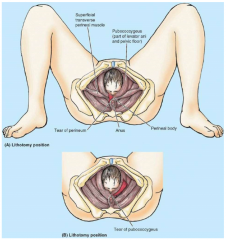 Structures of the pelvic floor:1. Perineum2. Levator Ani (pubococcygeus and puborectalis often torn)3. Perineal Fascia
*deep perineal pouch muscles can also be damaged

Can cause urinary stress incontence, faecal incontinence and prolapse of uter...