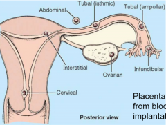 Ectopic pregnancy is when an embryo implants somewhere other than the uterus
The area of implantation may be too small to house the developing fetus (e.g. fallopian tube) or it may not have the high vascular supply needed (e.g. abdomen)