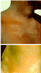 What skin infection is this? Describe clinical manifestations, causative organism, and diagnosis techniques. 
