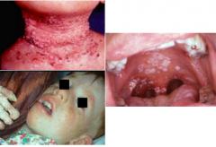 What organism caused these infections? Describe clinical manifestations, diagnosis, and transmission. 